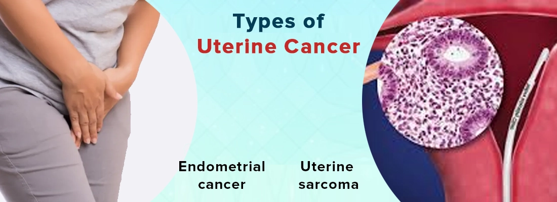 Types of Uterine Cancer